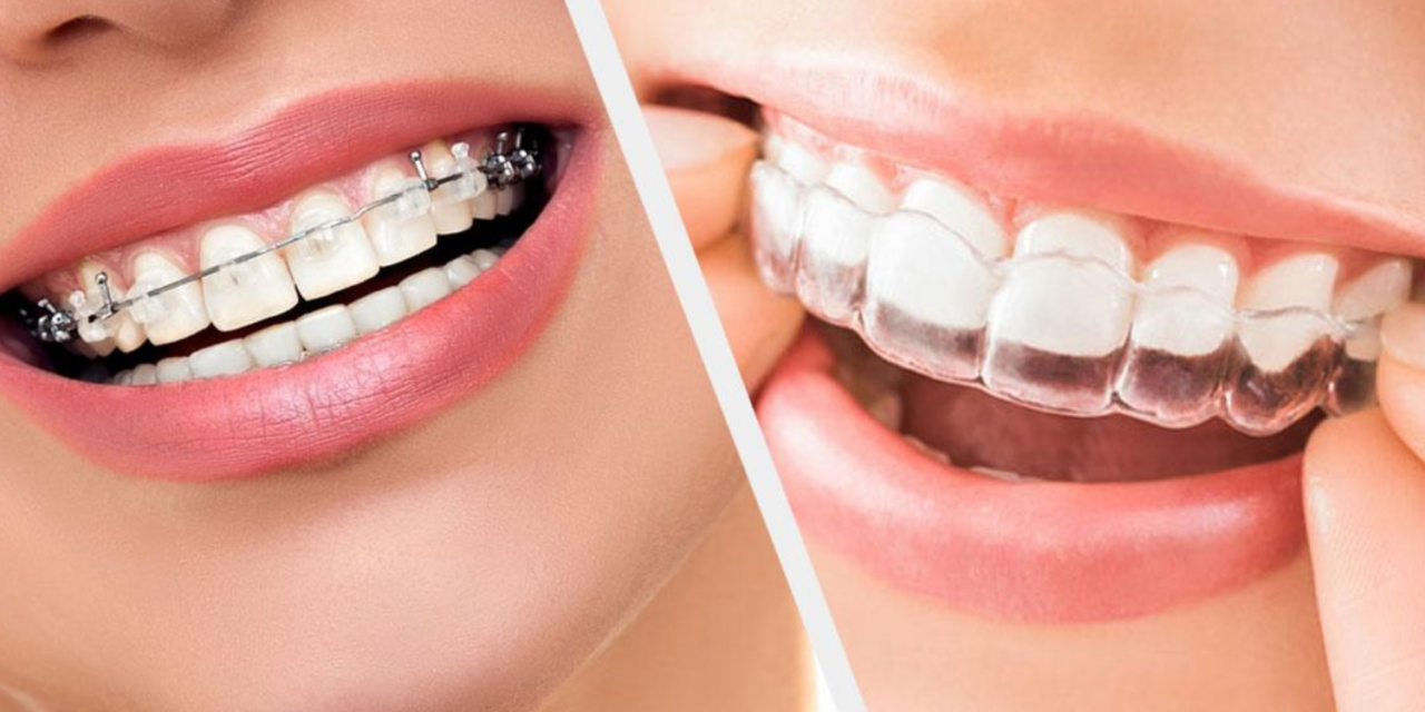 Cosmetic bonding: A modest treatment for the voids in your teeth