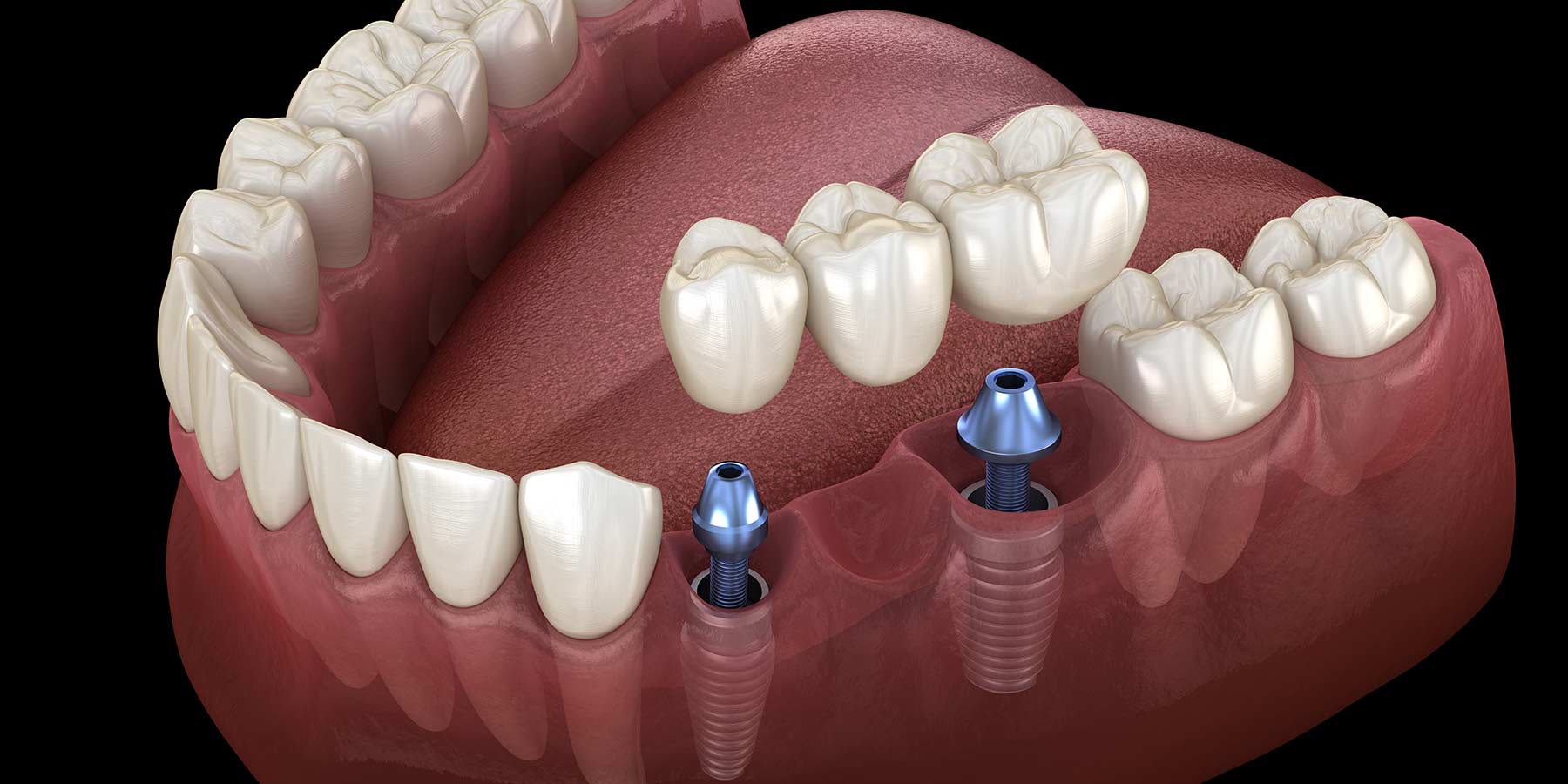 Dental Implants High Wycombe