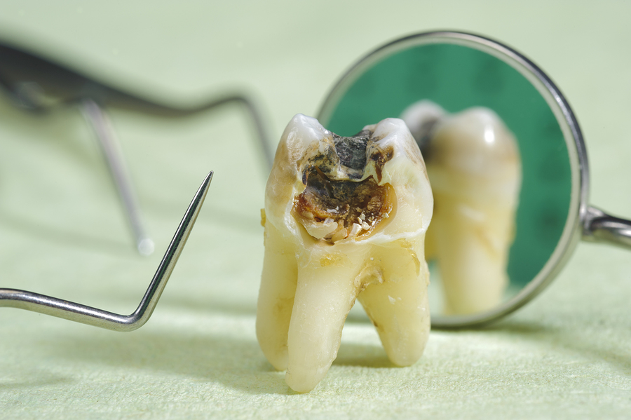 extracted tooth with cavities and dental equipment