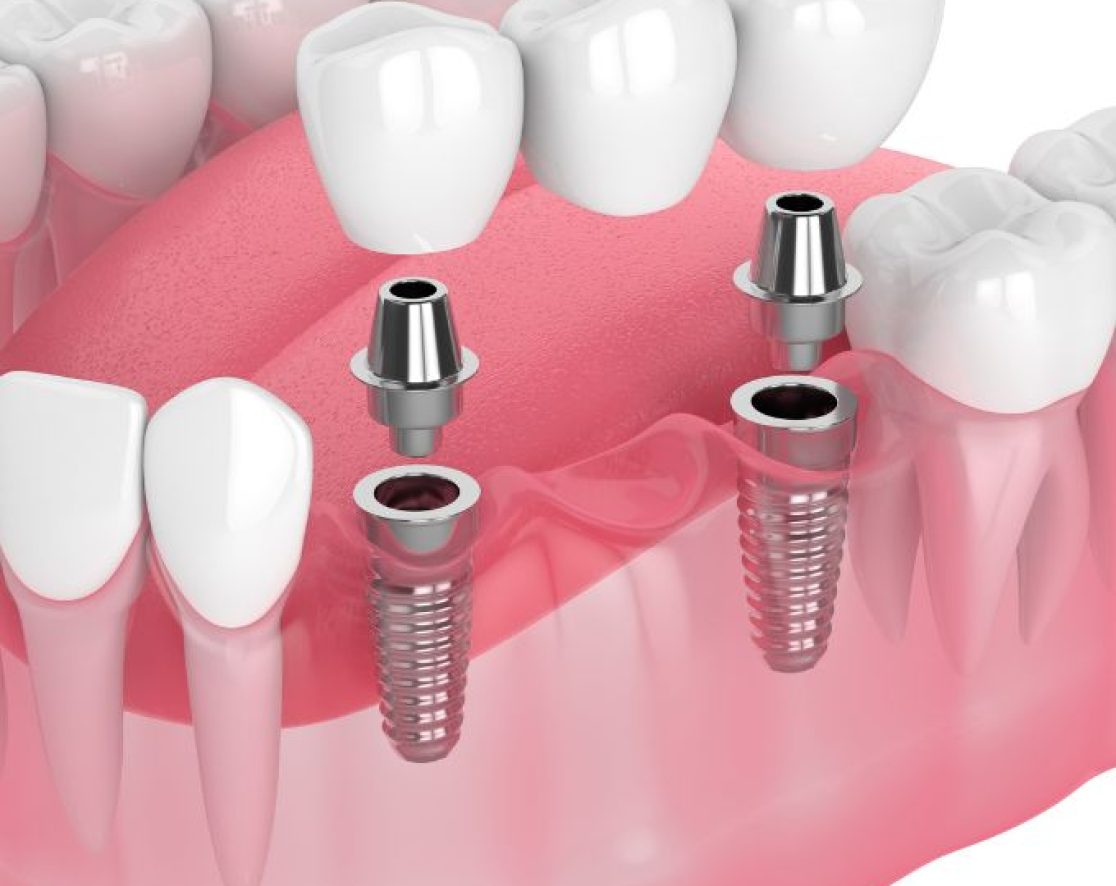 Implant retained bridges